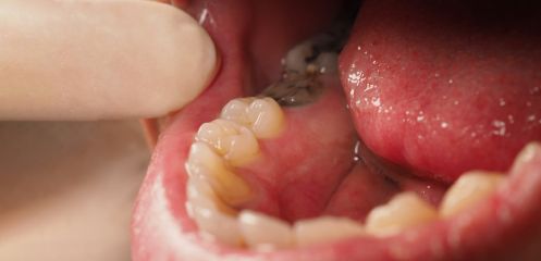 Severely decayed or fractured teeth beyond repair